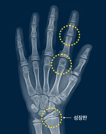 성장판