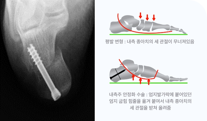 수술후