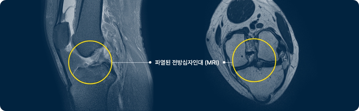 전방 십자인대 파열