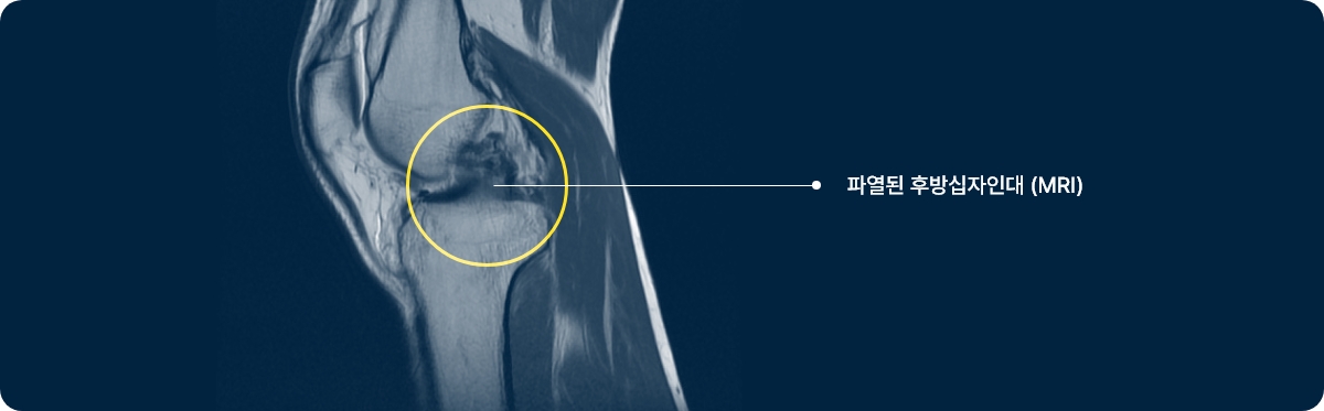 후방 십자인대 파열