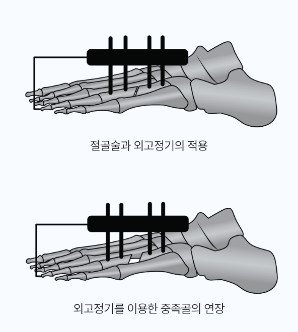 내고정법